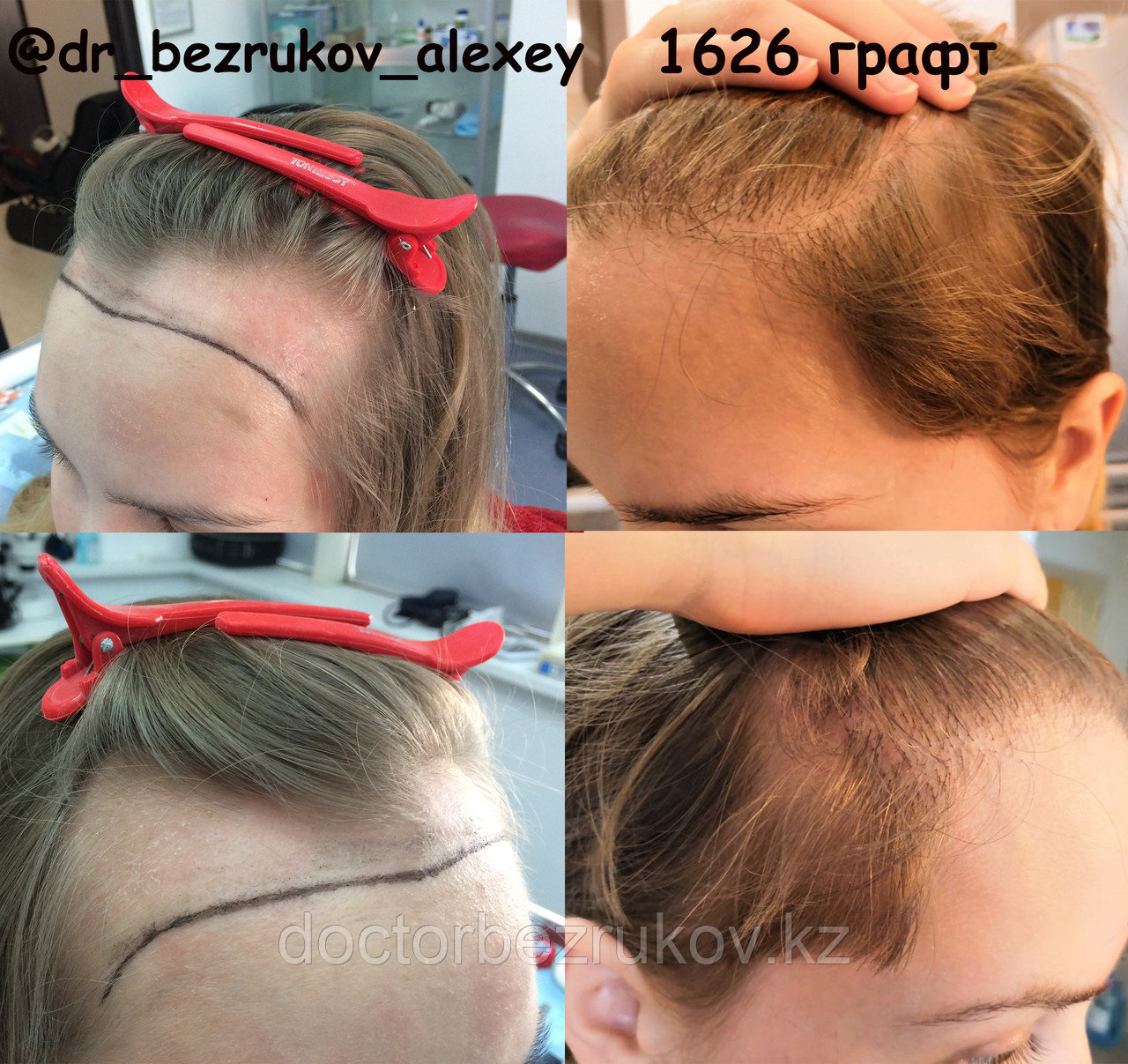 Пересадка бороды в Казахстане