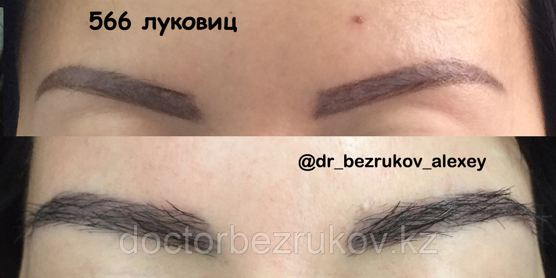 Пересадка бороды в Казахстане