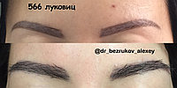 Пересадка бороды в Казахстане5
