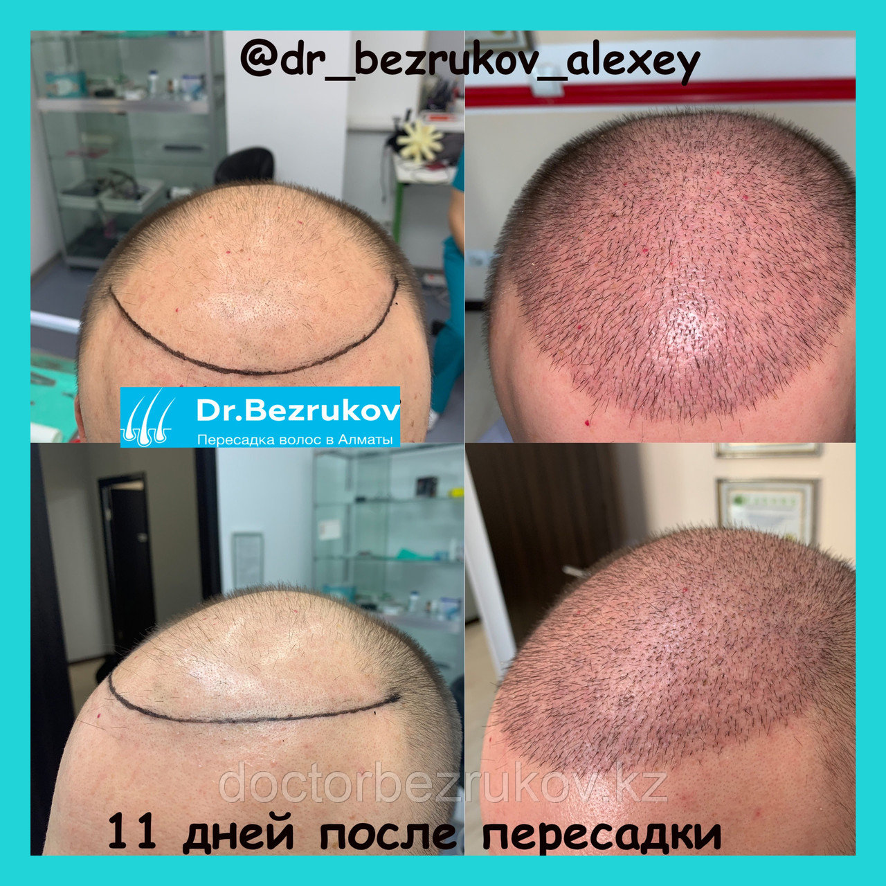 Пересадка волос в Алматы