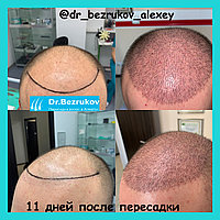 Пересадка волос в Алматы8