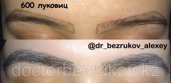 Трансплантация волос в область бровей