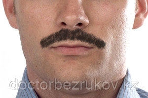 Пересадка волос на лицо