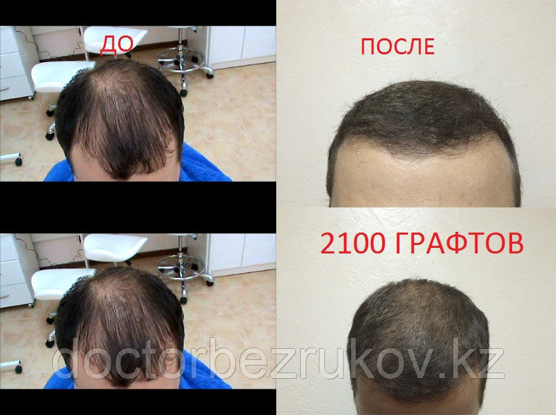 Пересадка бороды в Алматы