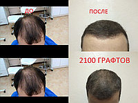 Пересадка бороды в Алматы1