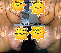 Пересадка волос на лицо9