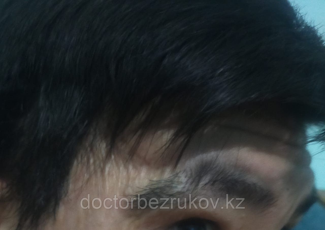 Пересадка бровей