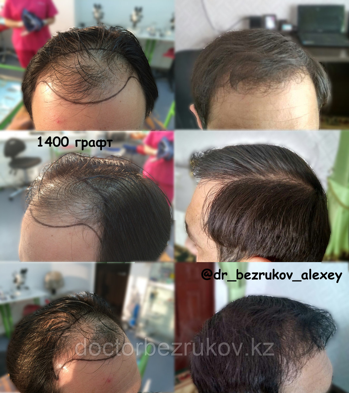 Пересадка бороды в Казахстане