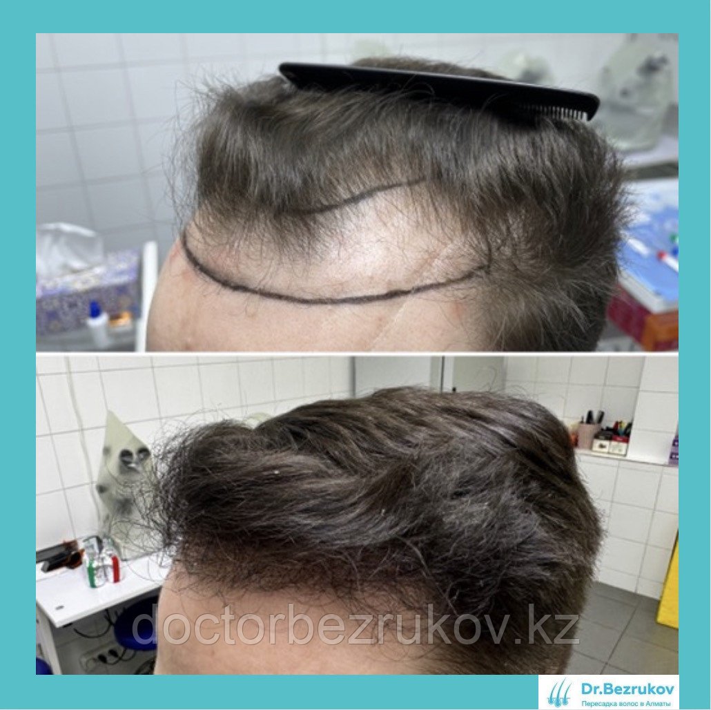 Пересадка волос методом фолликулярной экстракции в Алматы