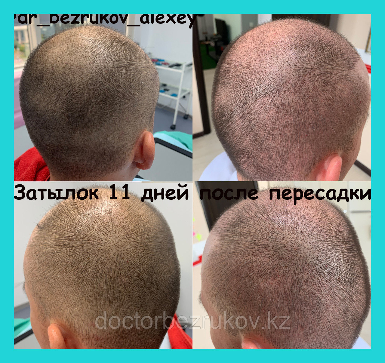 Пересадка волос в Алматы