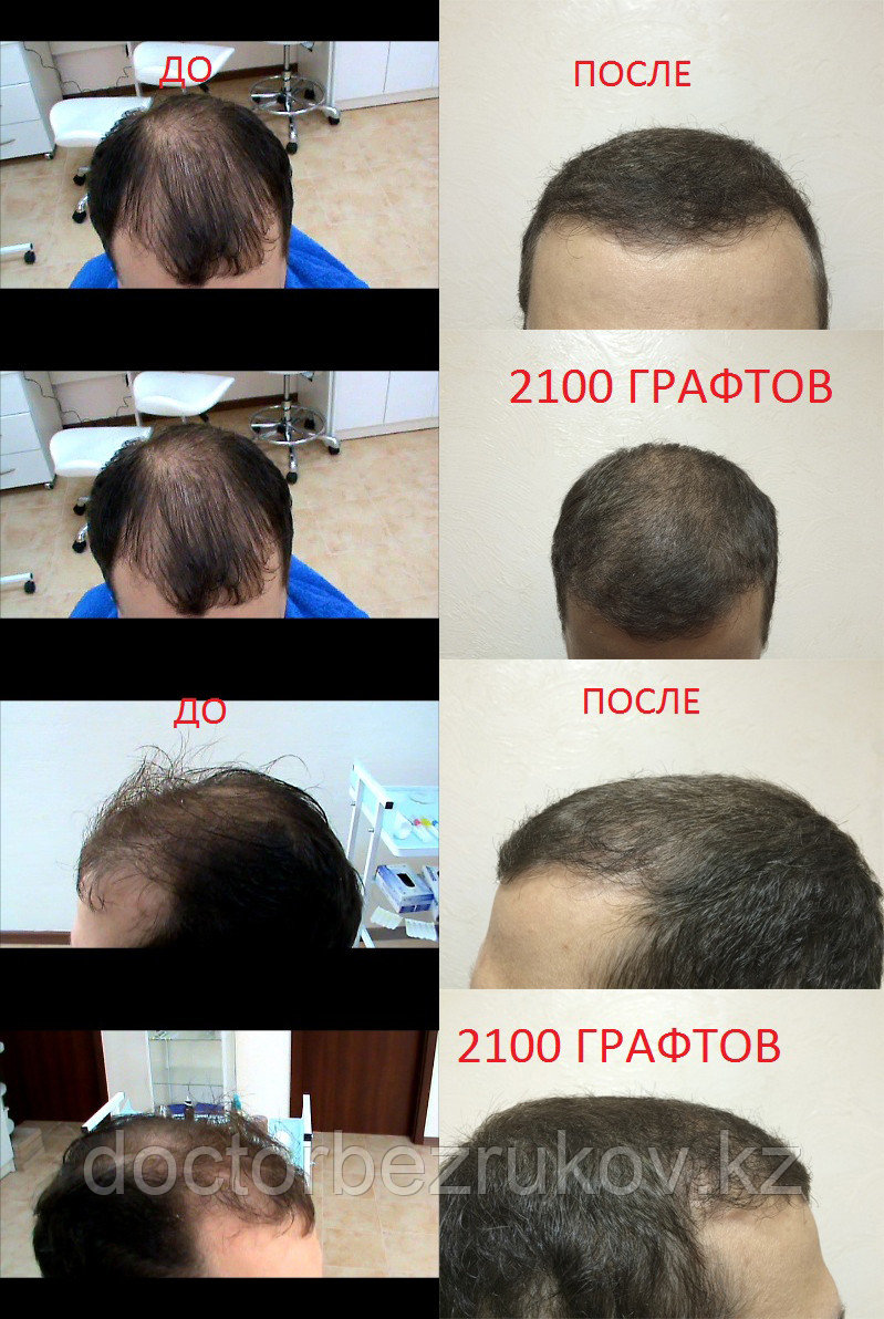 Пересадка бороды в Алматы