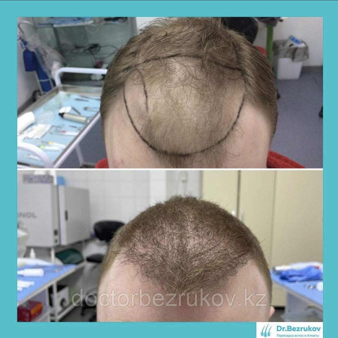 Пересадка волос у женщин в Алматы