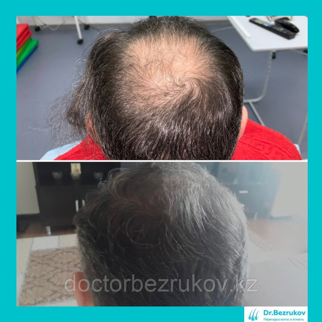 Рубцовая алопеция, пересадка волос
